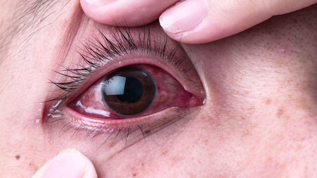 Bệnh viêm giác mạc bao lâu khỏi?