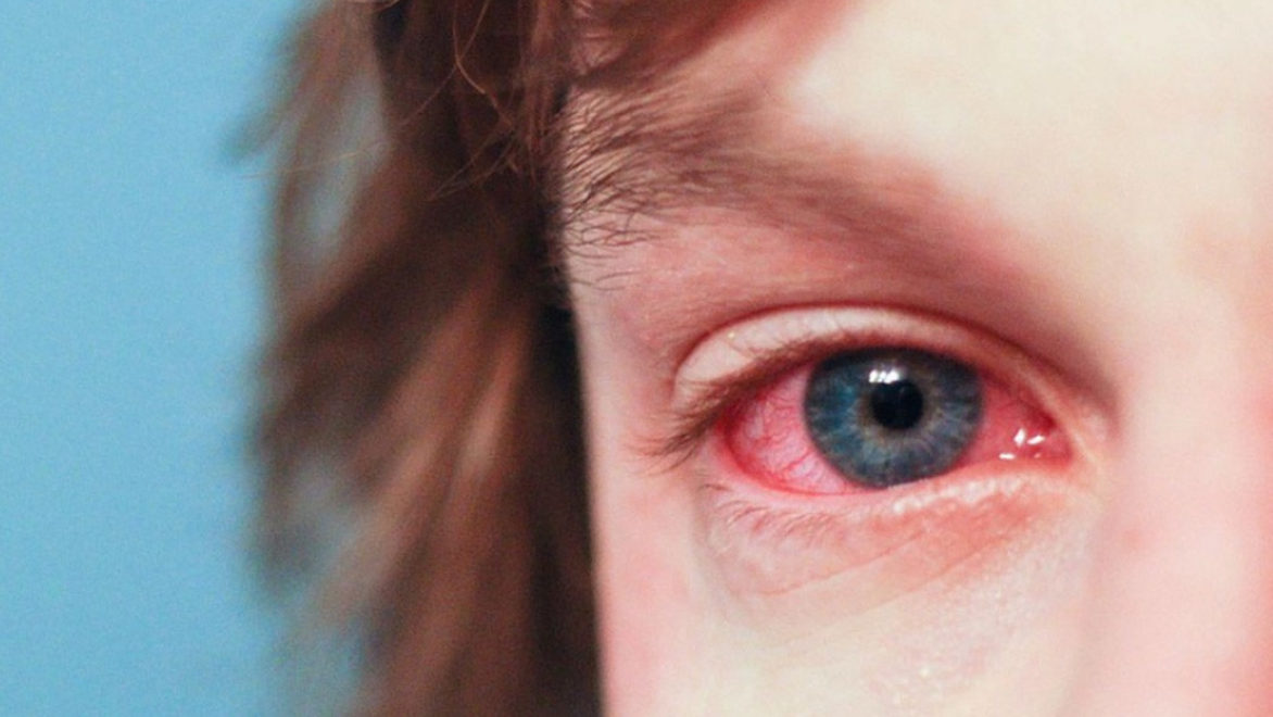 Thời gian khỏi bệnh viêm giác mạc phụ thuộc vào nhiều yếu tố