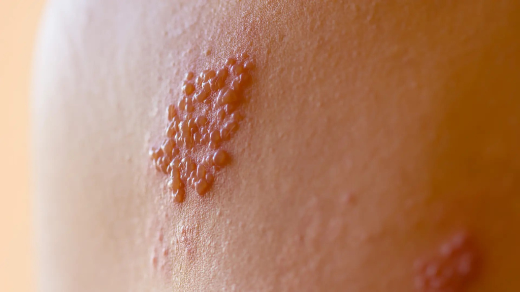 benh-zona-than-kinh-co-lay-khong-lay-qua-duong-nao 5.png