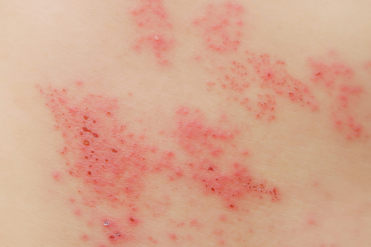 benh-zona-than-kinh-nen-an-gi-cac-thuc-pham-can-han-che 1.png