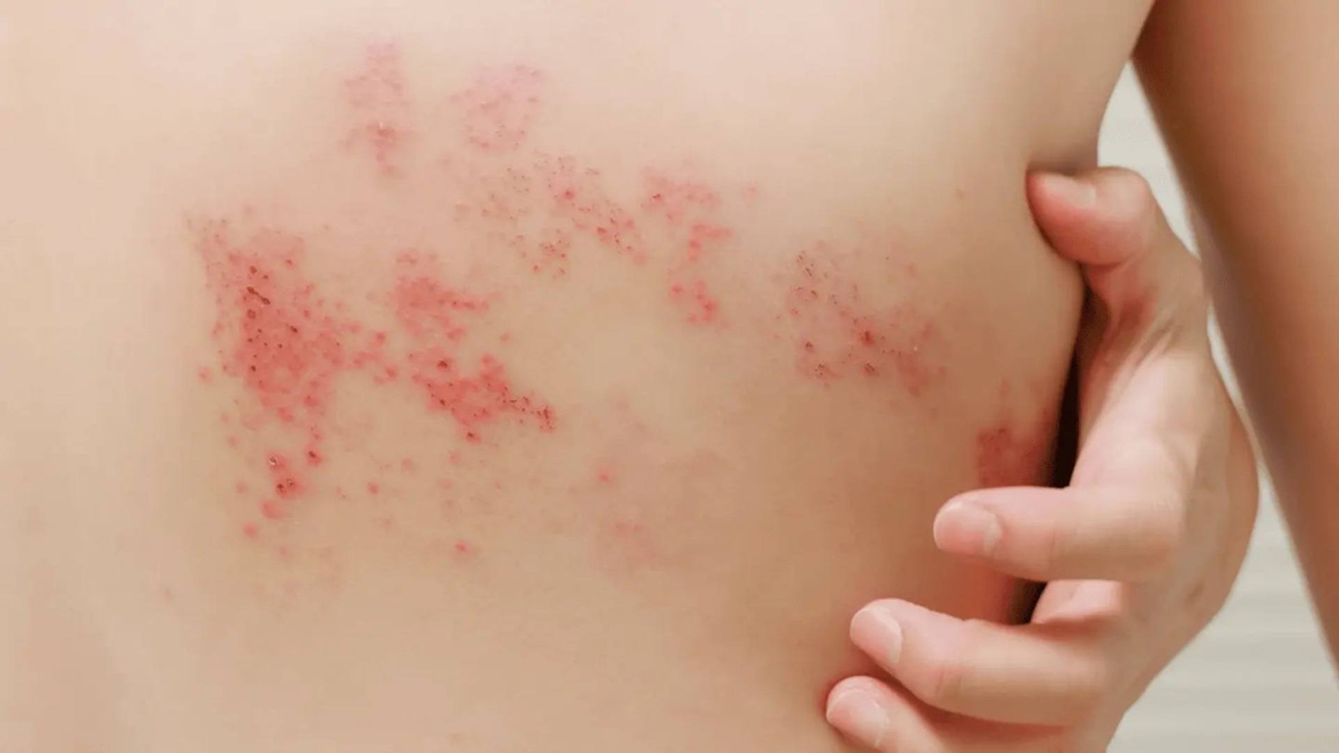 Bạn biết gì về bệnh zona thần kinh ở lưng? 0
