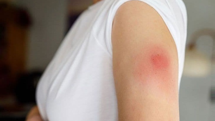 Bị áp xe vết tiêm là tình trạng hình thành ổ mủ tại vị trí tiêm thuốc, tiêm vắc xin hoặc tiêm truyền do nhiễm trùng