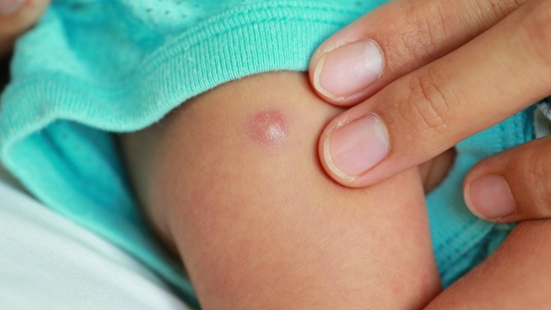 Sau vài ngày, tại vị trí tiêm có thể nổi lên một khối cứng dưới da