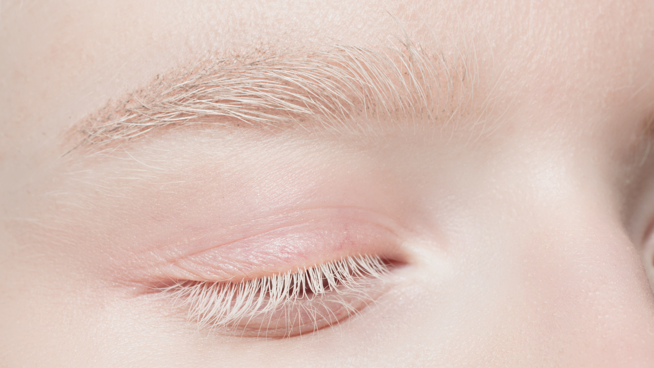 Bị bệnh bạch tạng có nguy hiểm không?