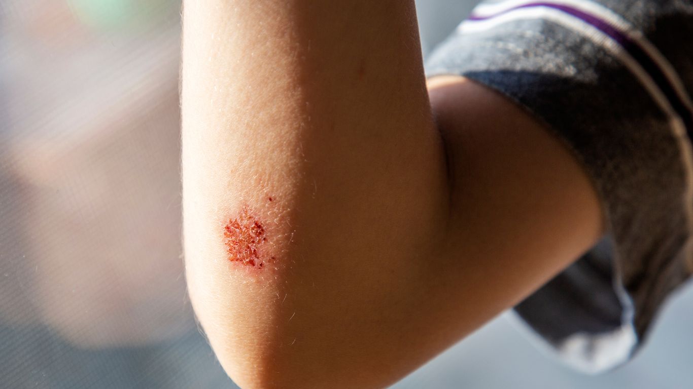 bi-cam-co-tiem-uon-van-duoc-khong 1