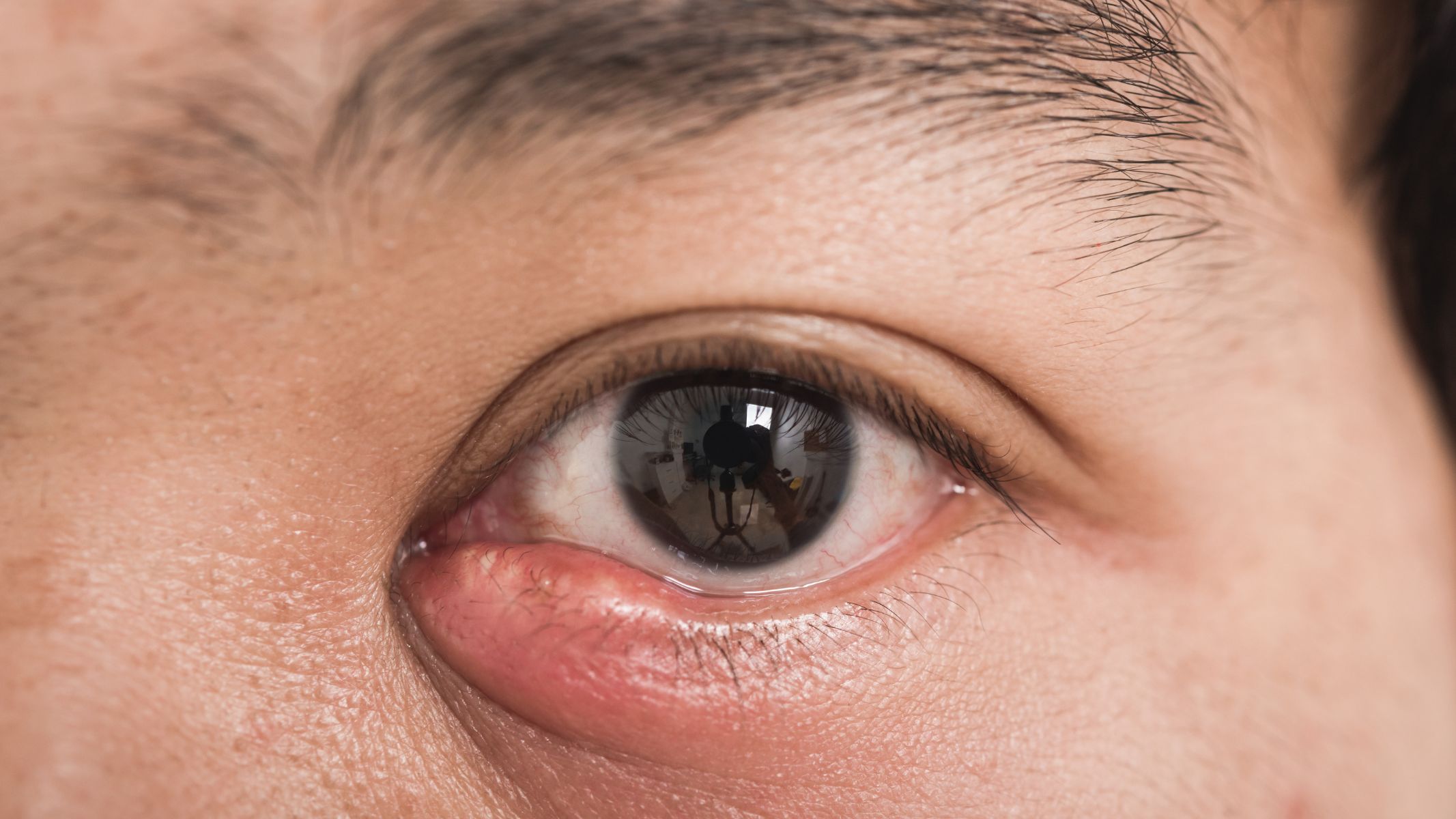 Bị chắp mắt có nên mổ không?