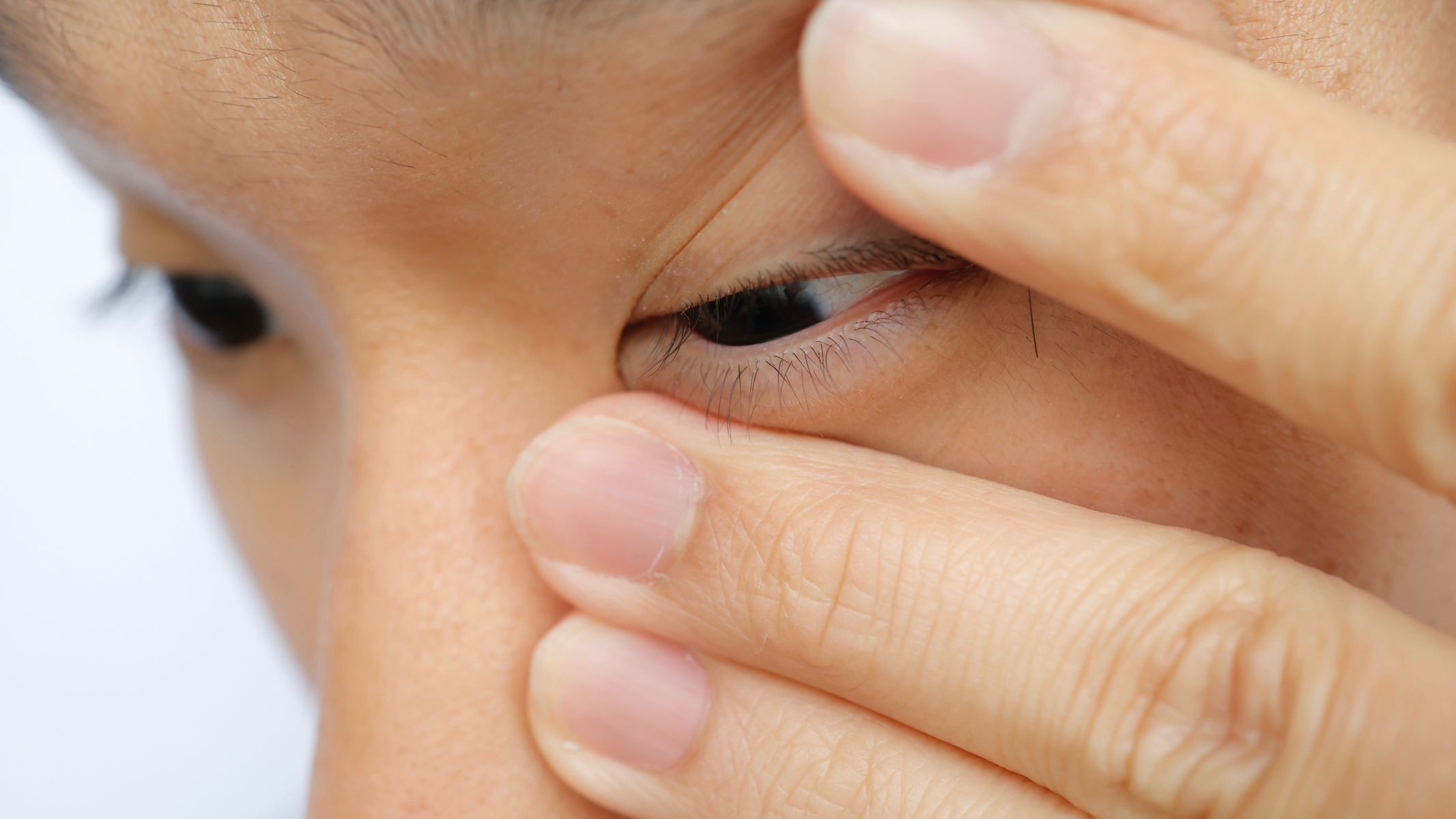 Người bệnh cần hạn chế chạm tay vào mắt, tránh tiếp xúc trực tiếp với vùng sưng