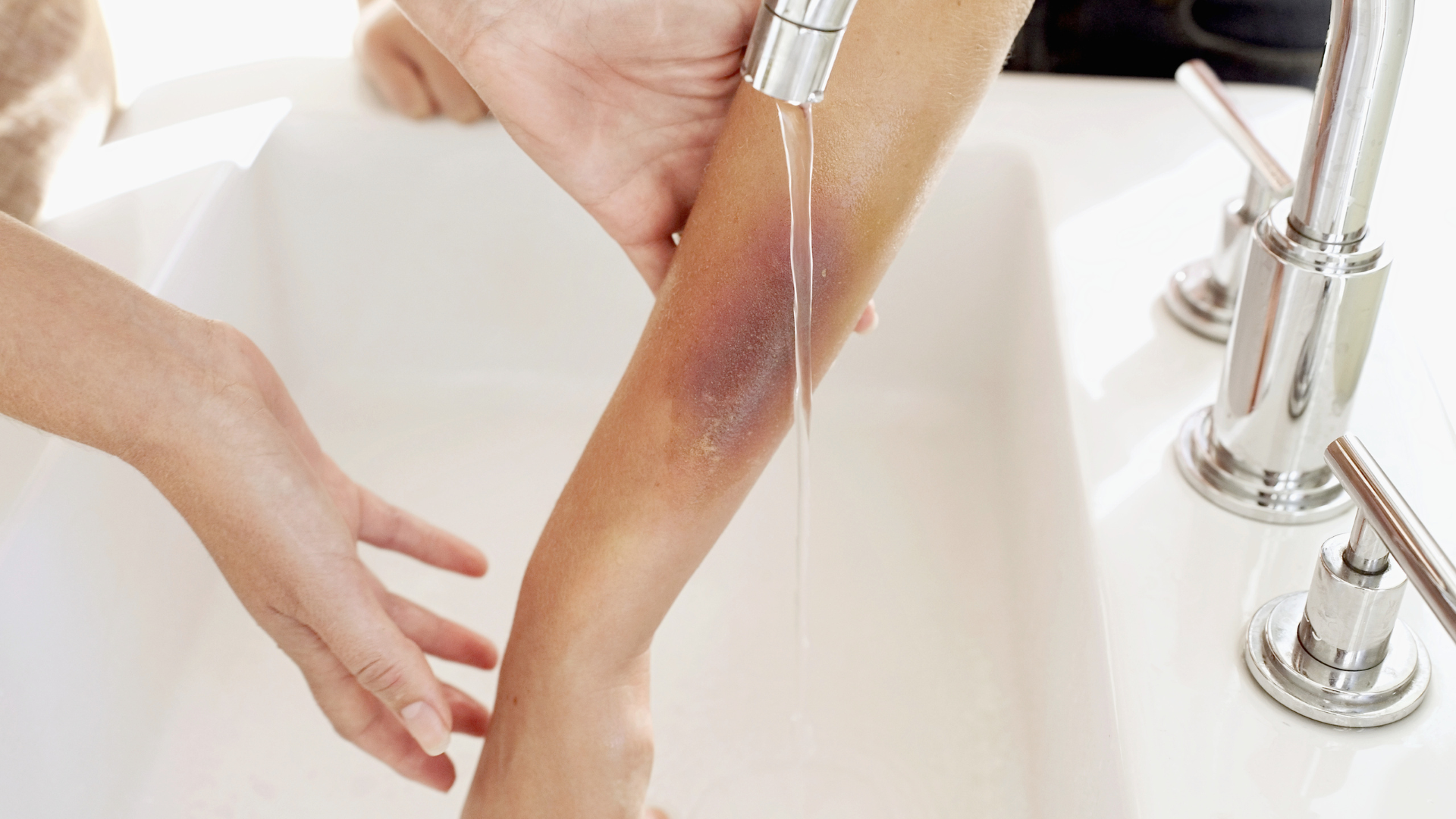 Xử trí đúng khi bị chuột cắn giúp giảm nguy cơ biến chứng