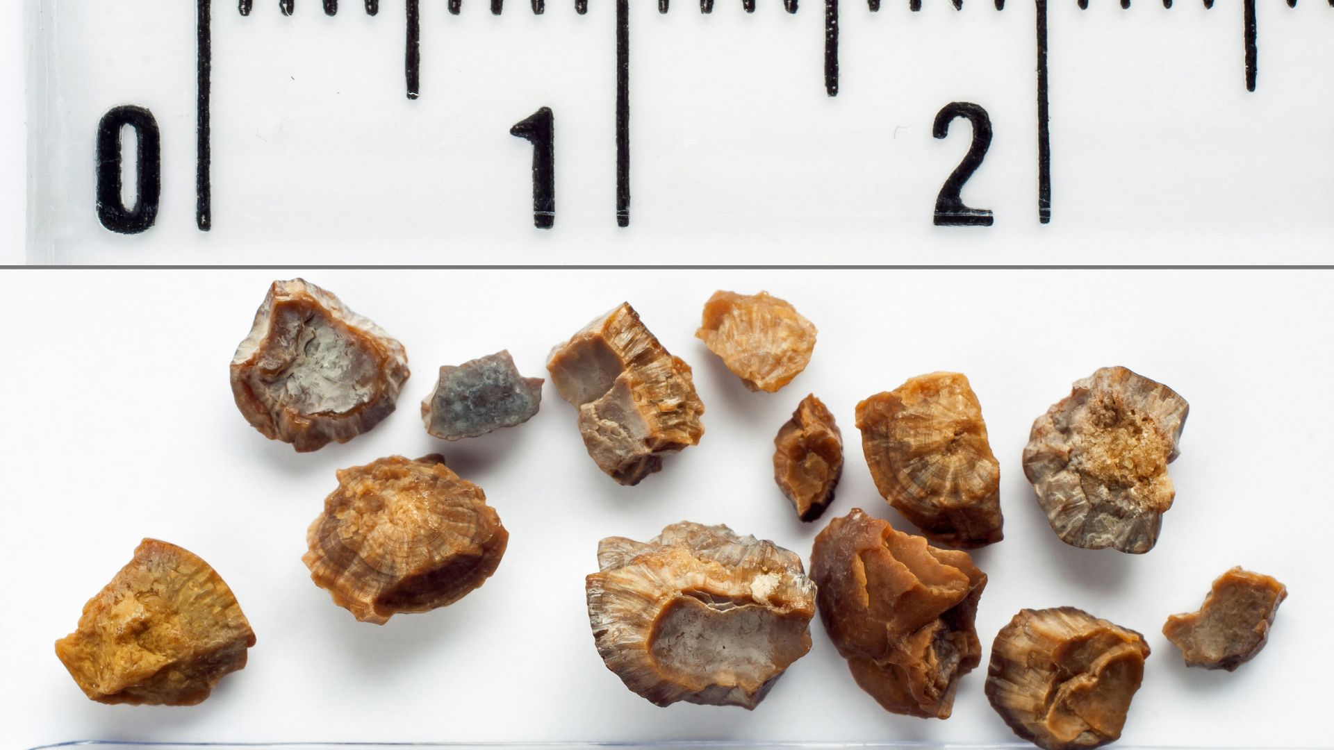 Nam giới bị đau bụng dưới có thể do sỏi niệu đạo