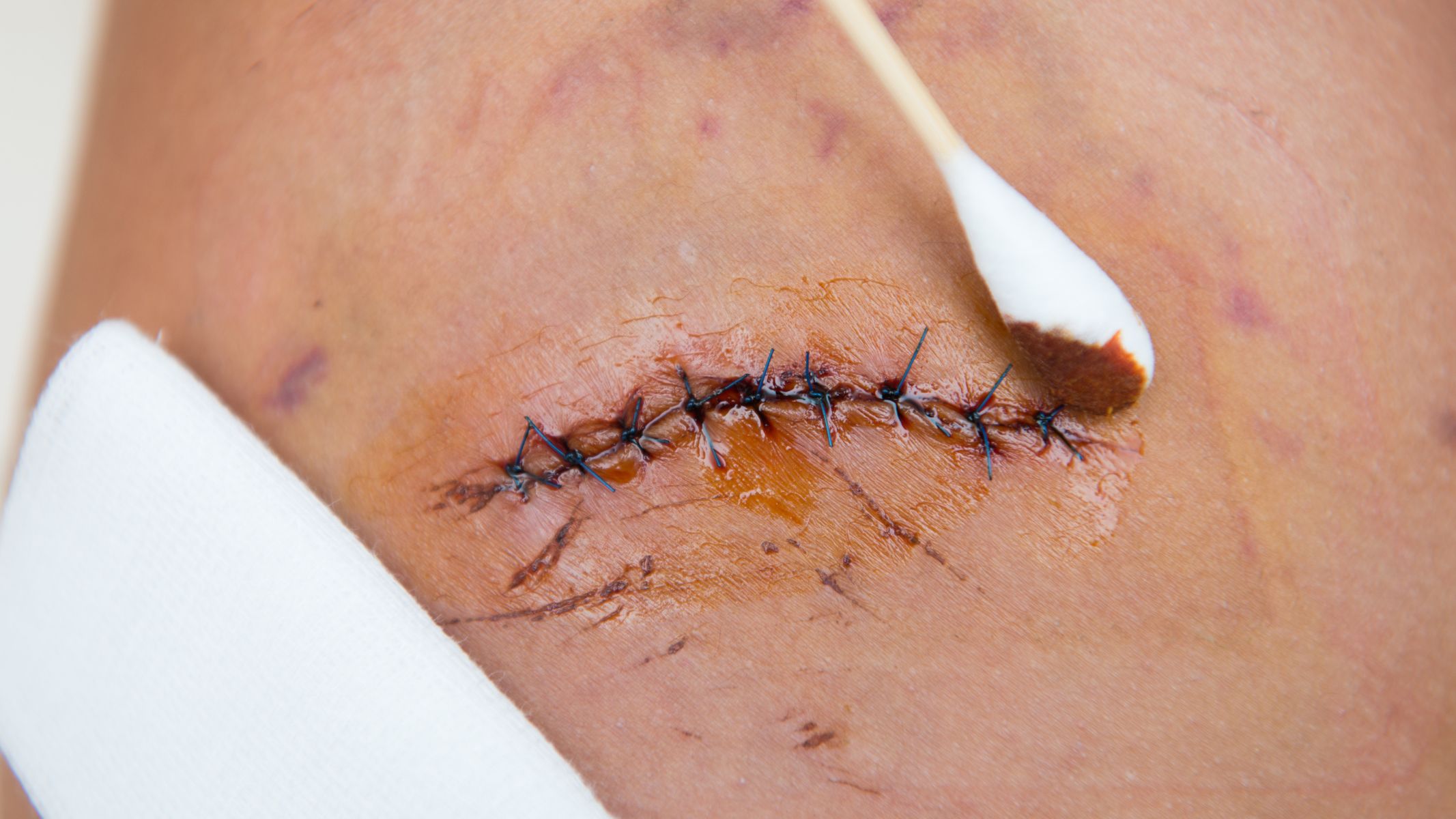 Rửa nhẹ vùng vết mổ, lau khô bằng khăn sạch và đảm bảo khu vực này luôn khô ráo