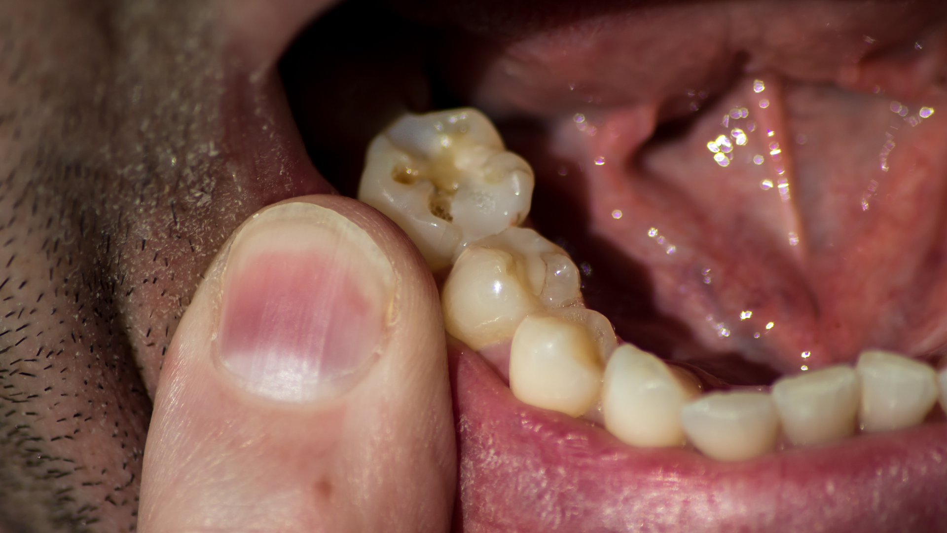 Các vấn đề răng miệng có thể gây đau lan sang vùng quai hàm