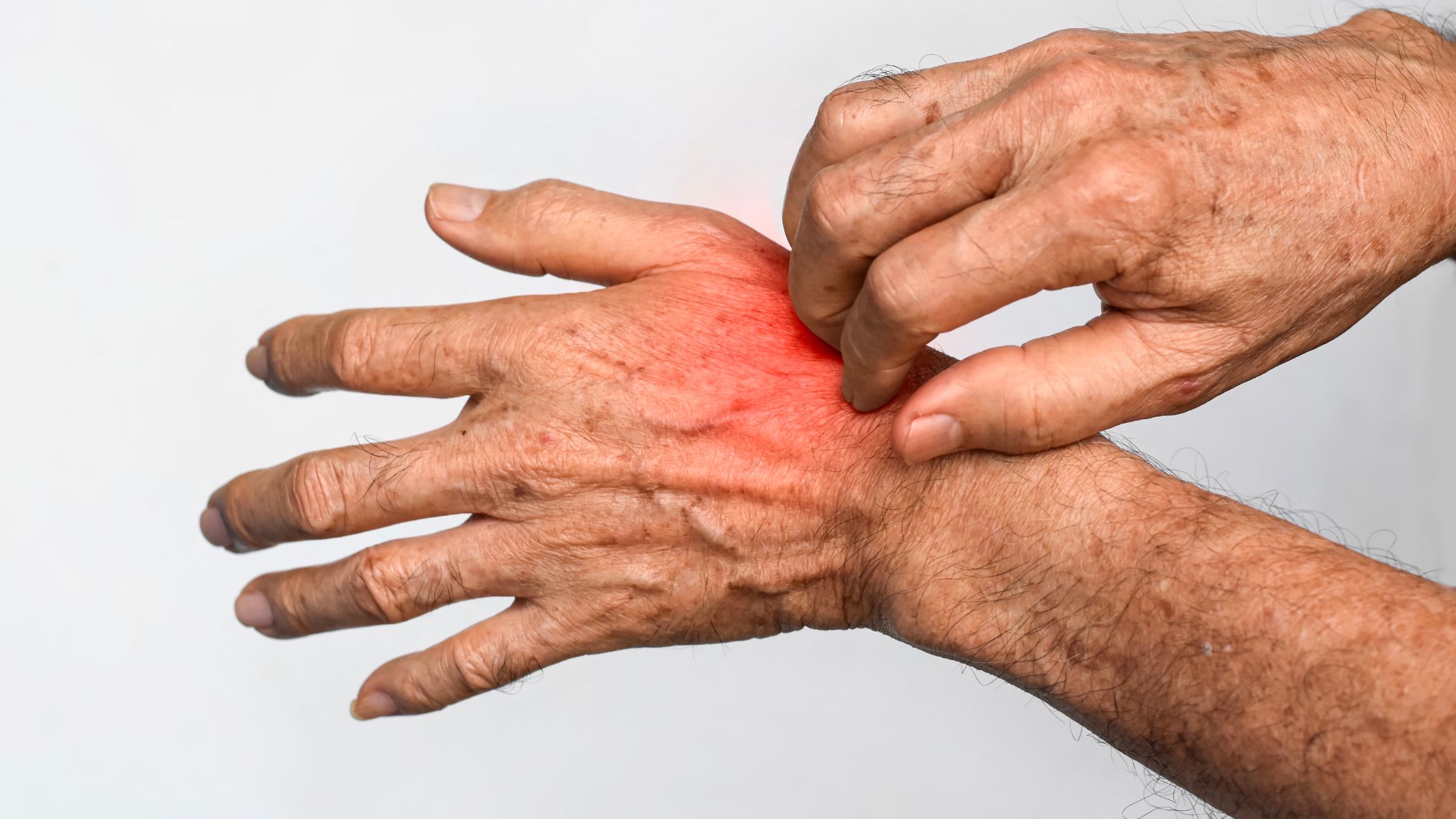 Triệu chứng của bệnh ghẻ nước thường không biến mất tự nhiên nếu không được can thiệp y tế