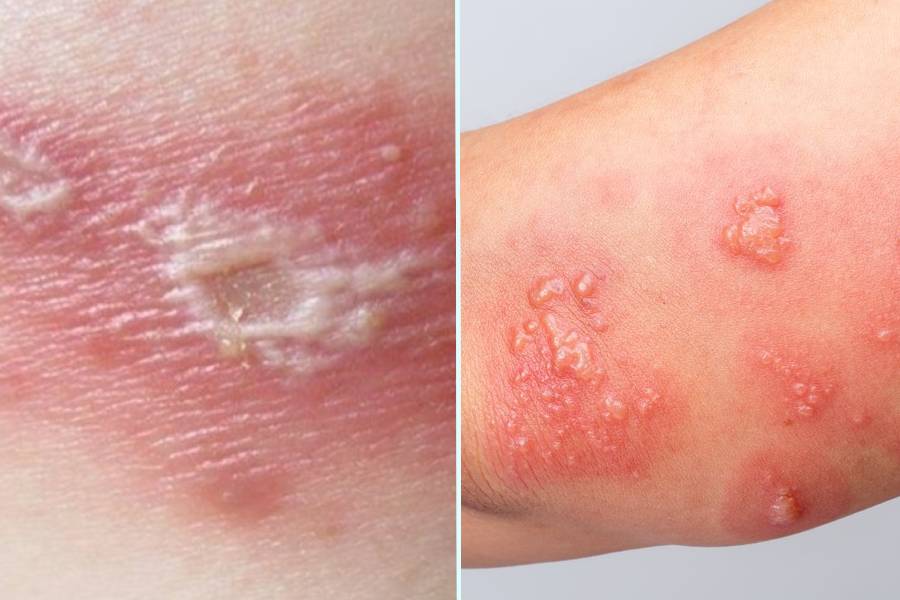 Bị kiến ba khoang cắn có sao không? Dấu hiệu nhận biết và cách phòng tránh hiệu quả 2