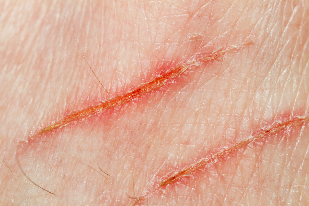 bi-meo-cao-chay-mau-co-can-tiem-phong-khong-4-tac-hai-kho-luong 4.png