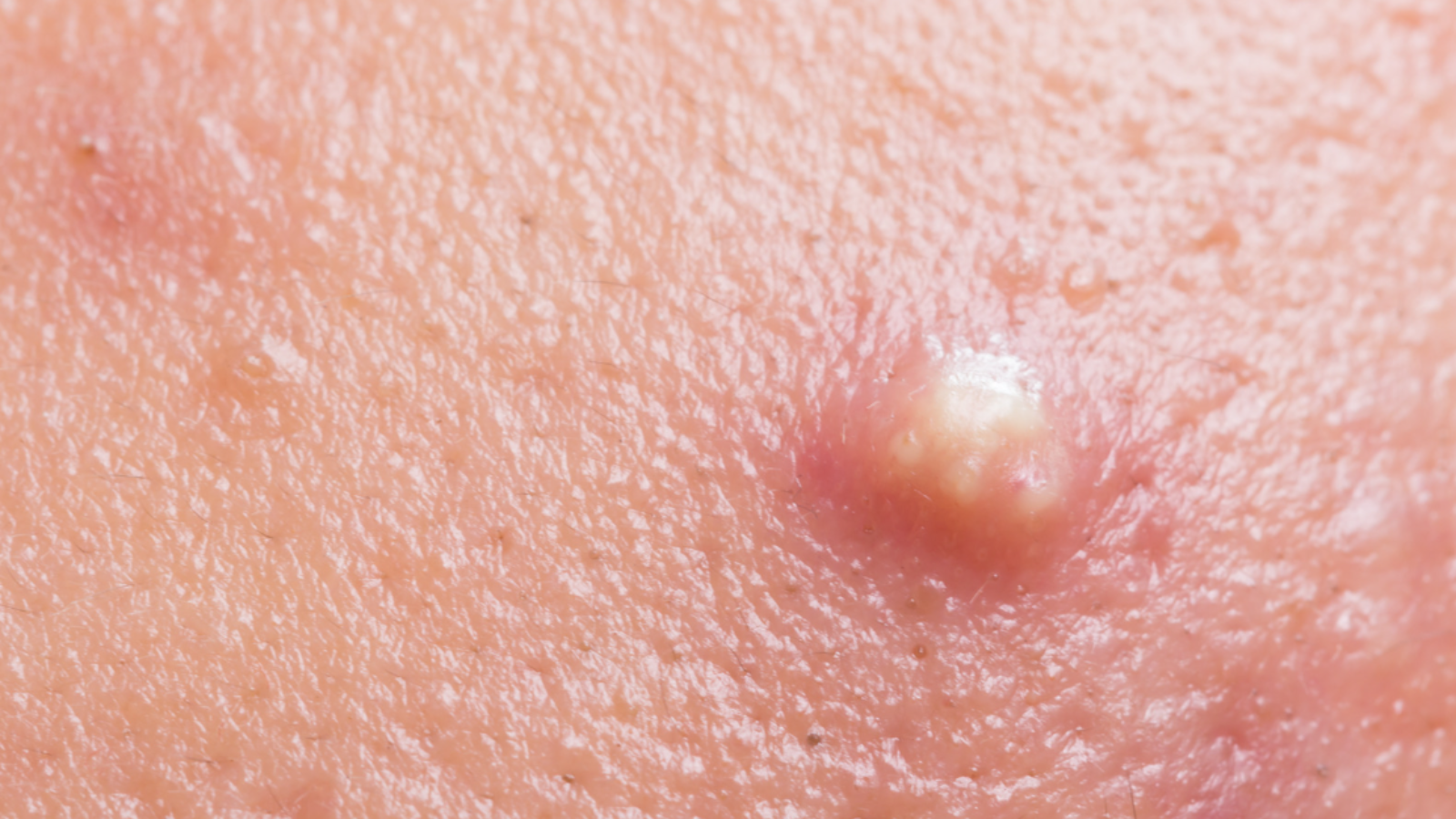 Bị mụn nhọt ăn xôi được không? 2