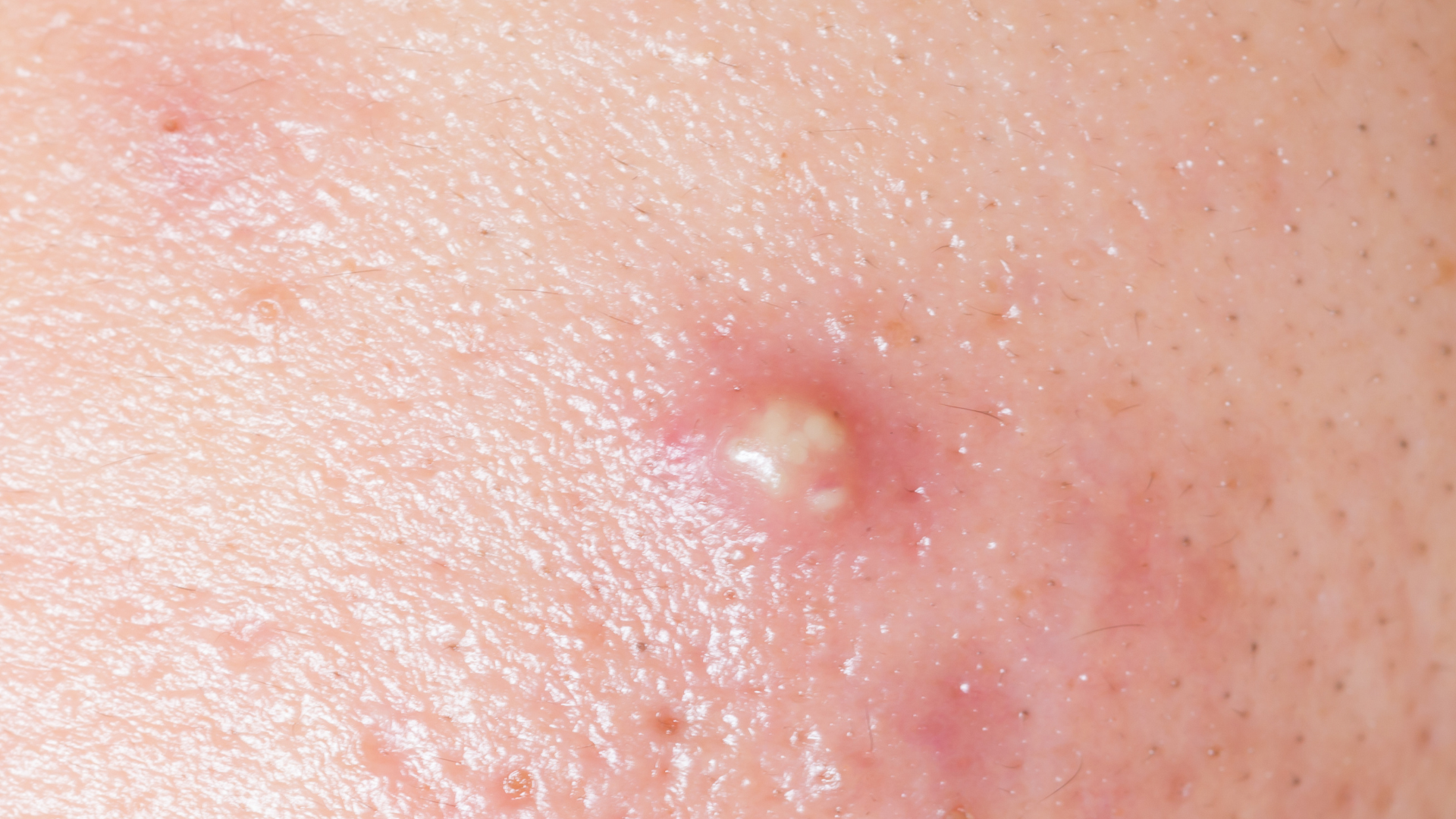 Hướng dẫn xử lý mụn nhọt an toàn tại nhà khi đáp ứng đủ điều kiện