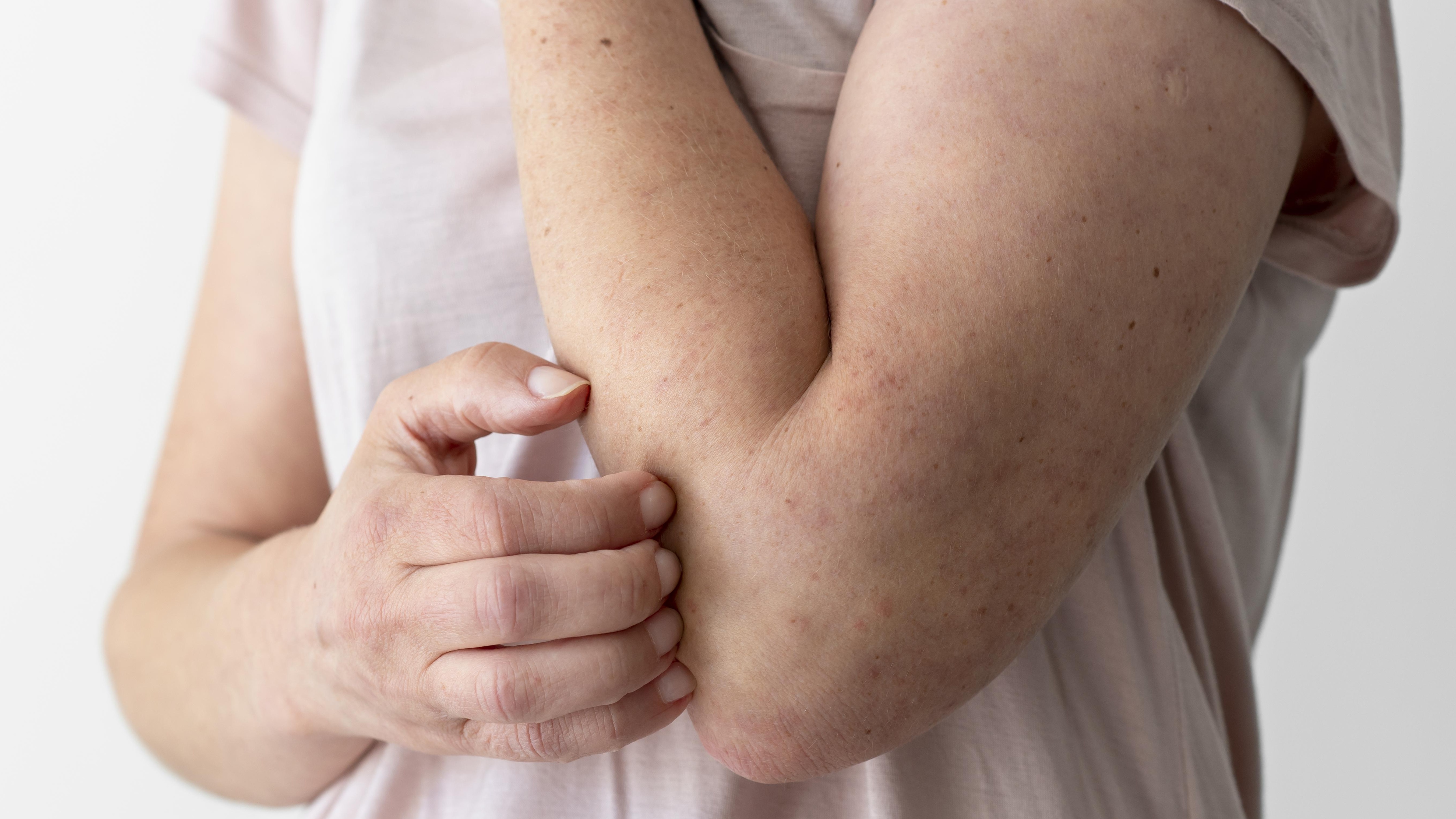 Dị ứng mỹ phẩm gây ngứa da