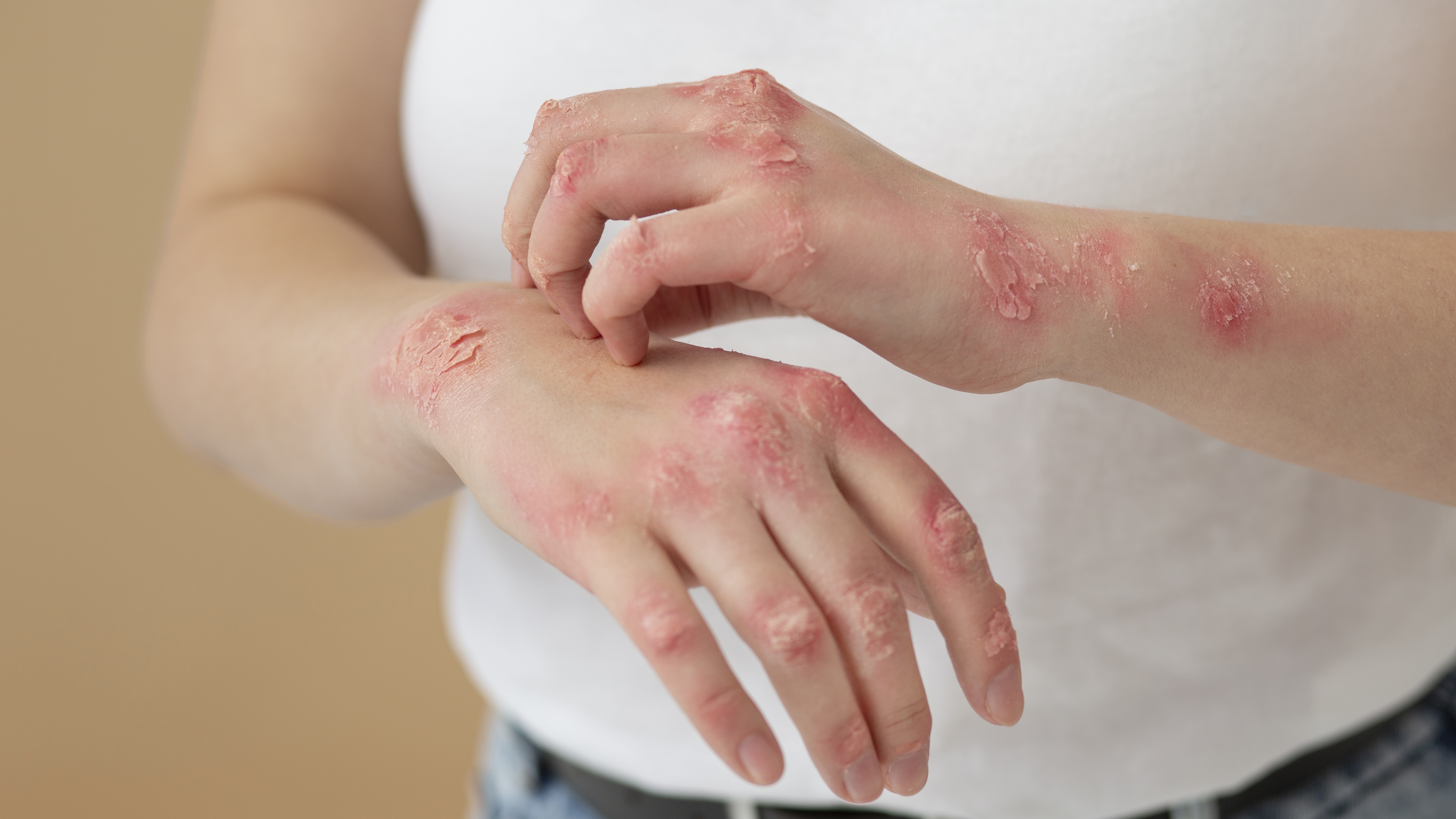 Nhiều nguyên nhân gây nên tình trạng bị ngứa khắp người