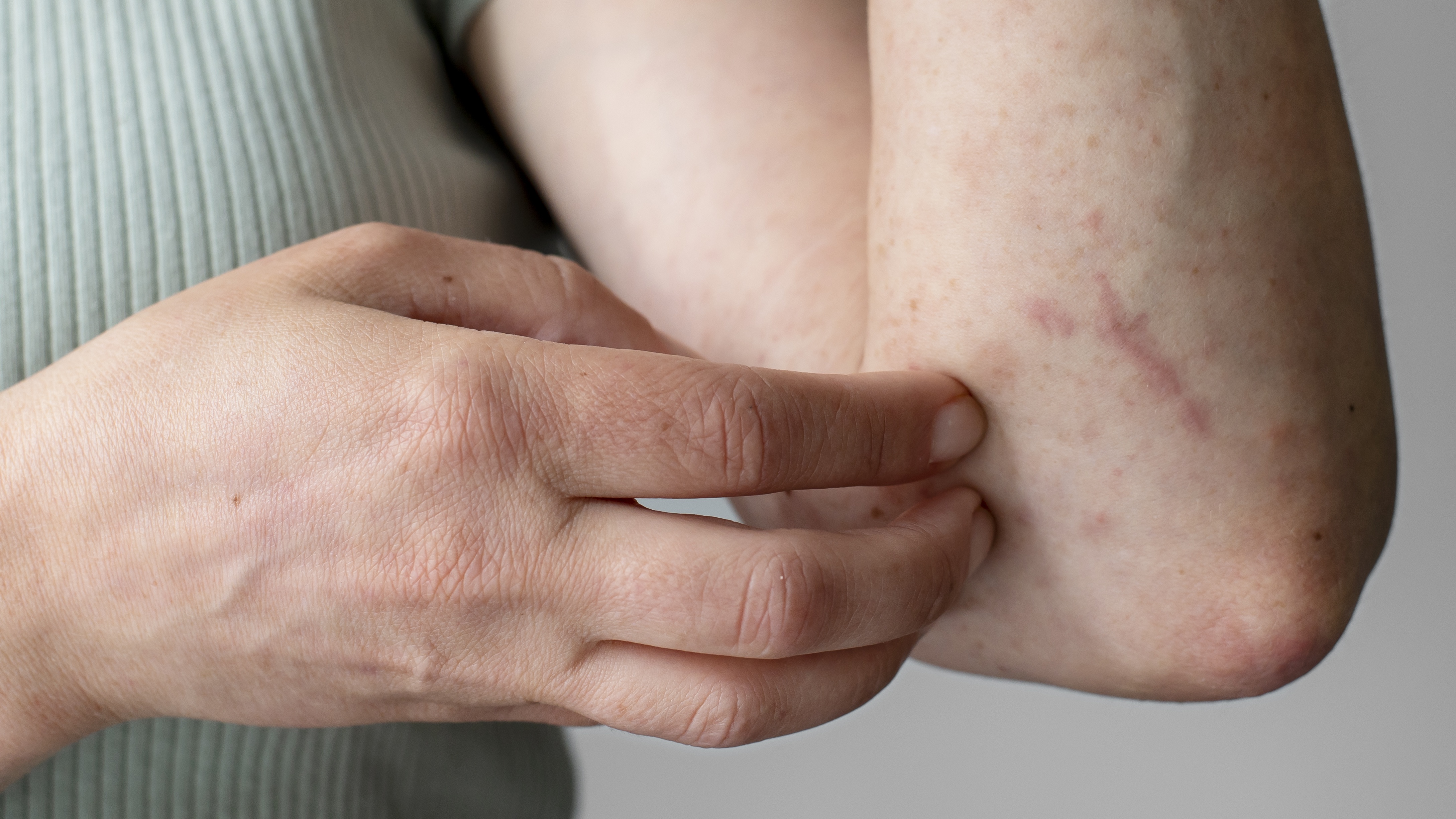 Da nổi mẫn, phát ban gây khó chịu