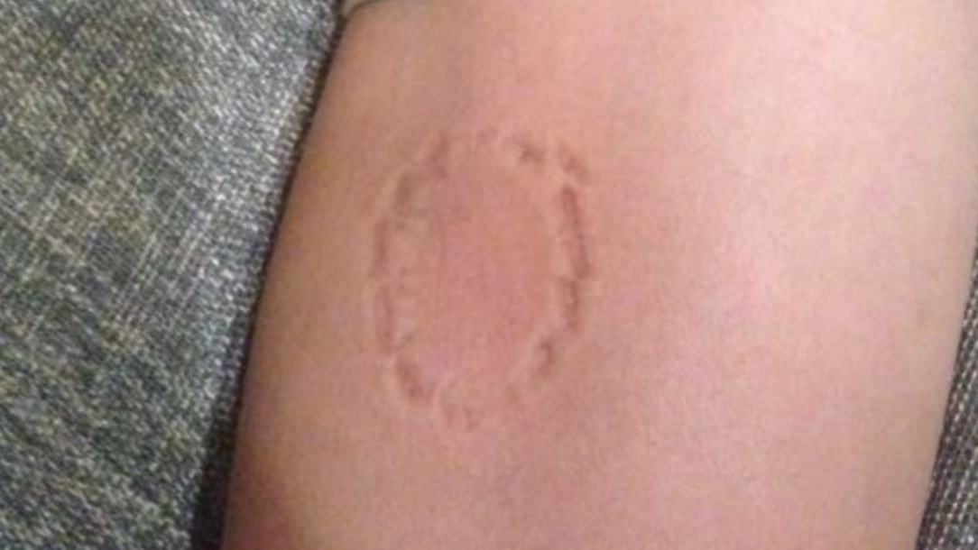 Nhiều người lo lắng khi bị người cắn