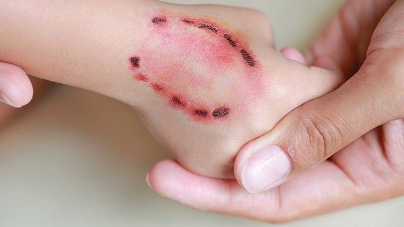 Bị người cắn có sao không?