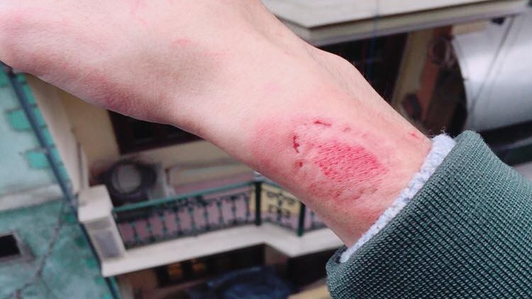 Vết thương sưng đỏ là dấu hiệu bị viêm trùng