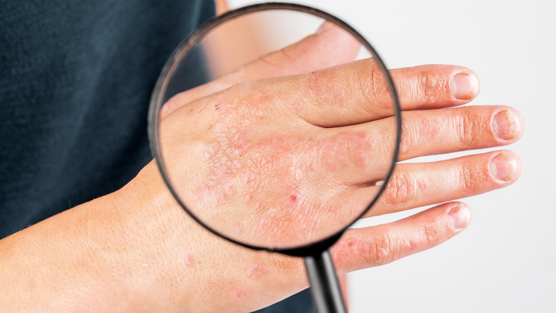 Khi bạn bị nổi mề đay liên tục, việc chăm sóc tại nhà đóng vai trò quan trọng