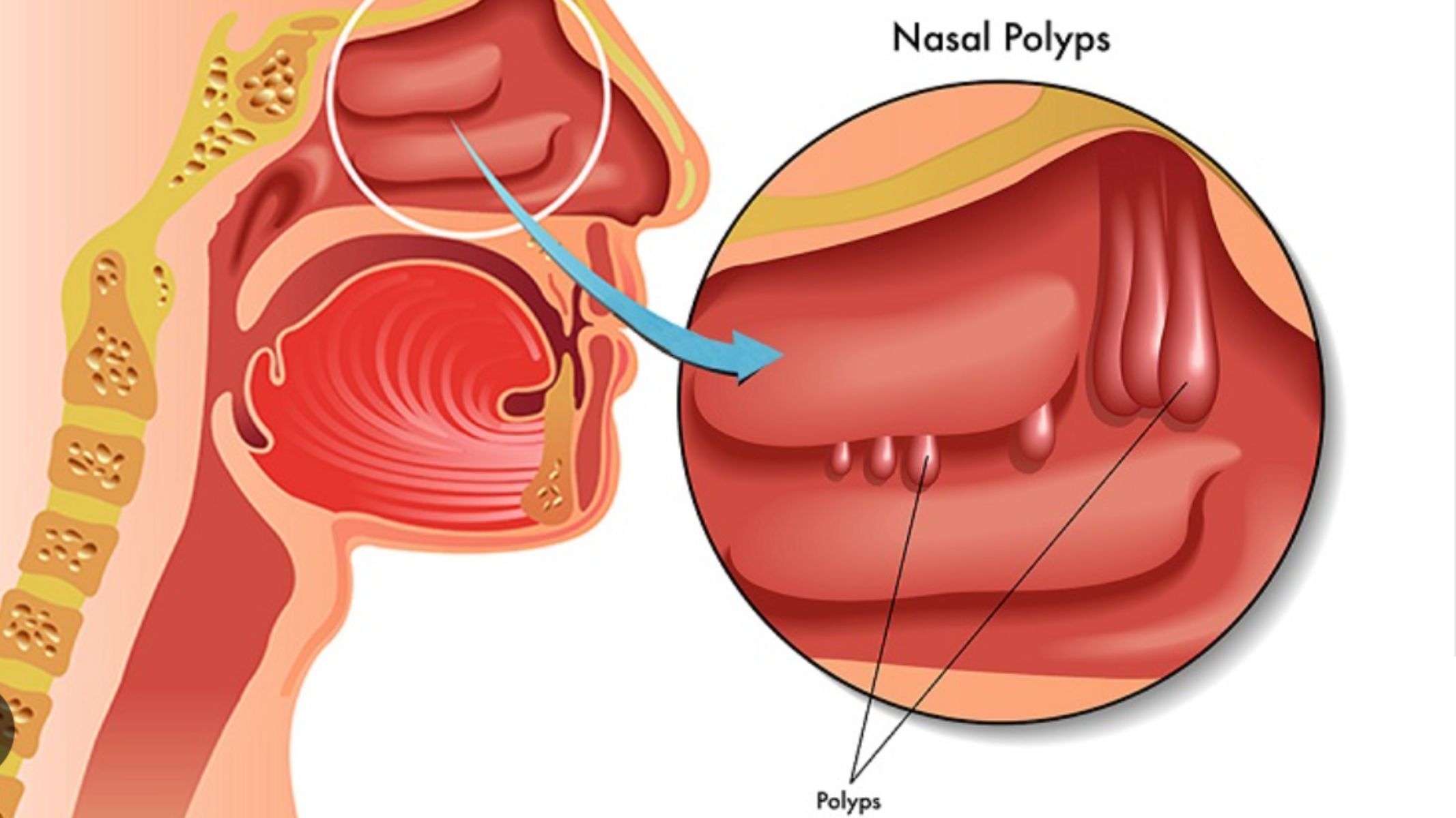 Bị polyp mũi có nên mổ không? Giải đáp từ chuyên gia 2