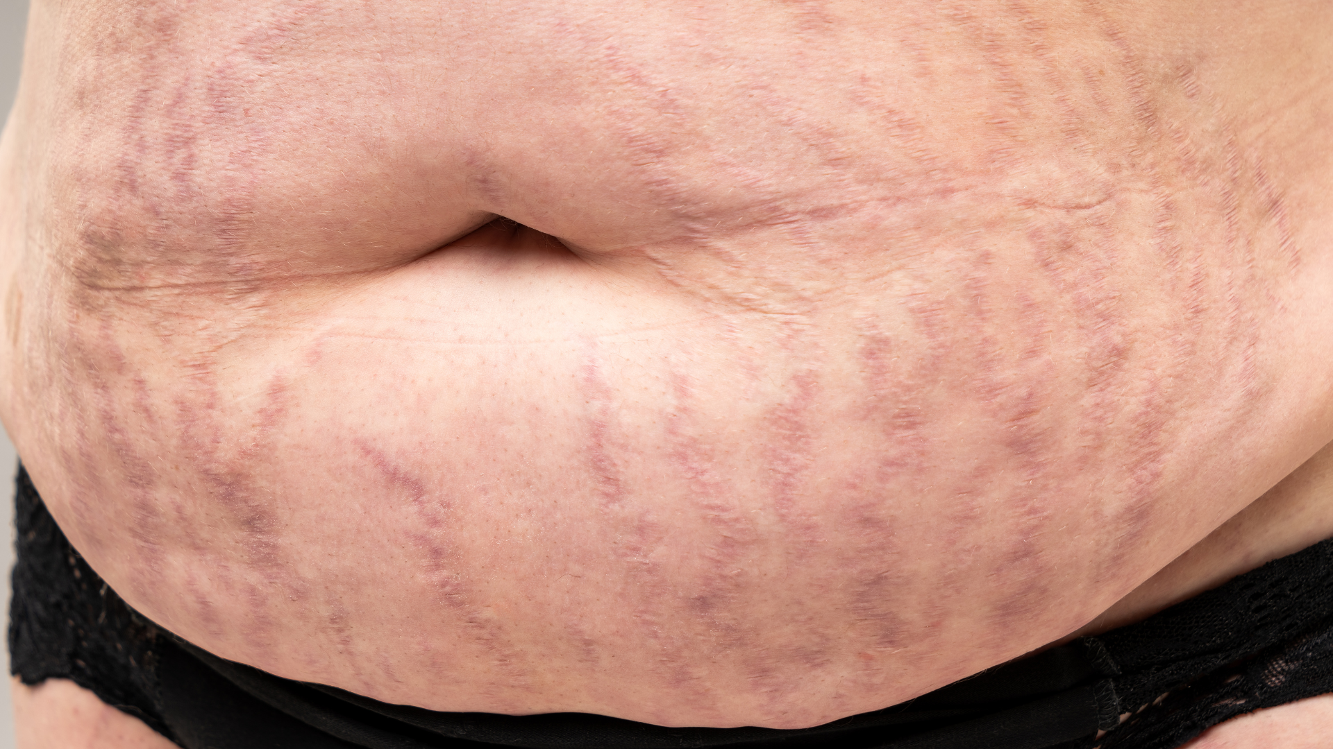 Nhiều người thường lo lắng không biết bị rạn da màu đỏ có tự hết không