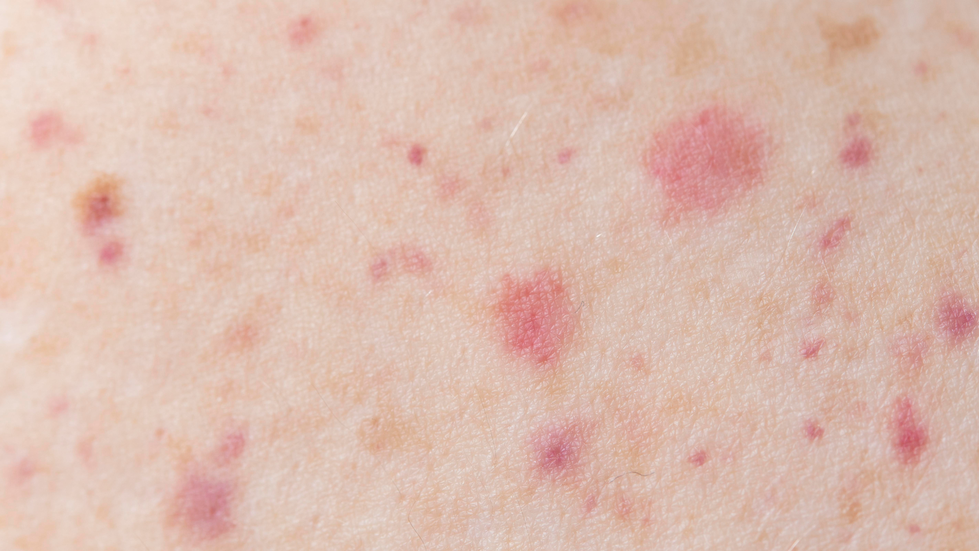 Nguy cơ lây HPV trong đời sống vợ chồng