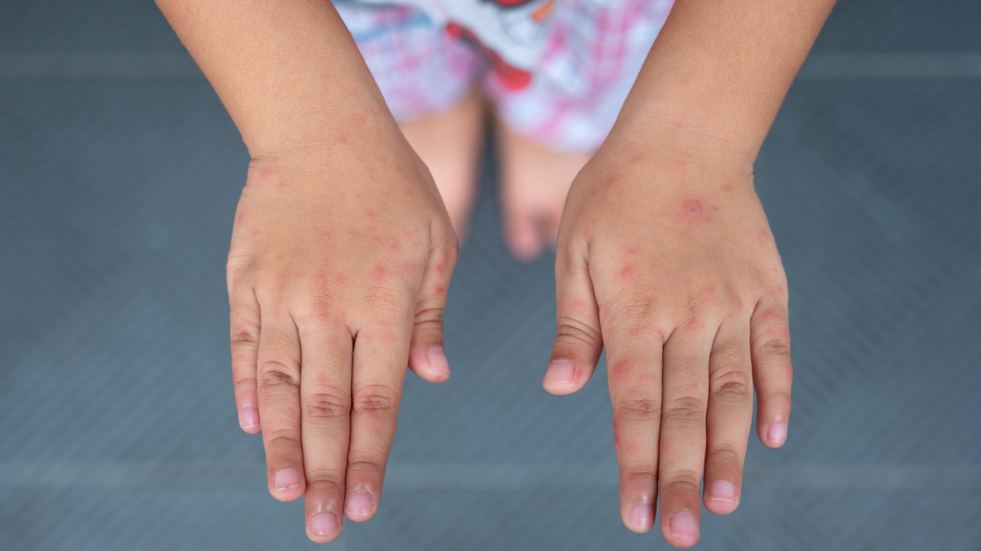 Phát ban và mụn nước là dấu hiệu đặc trưng của bệnh tay chân miệng