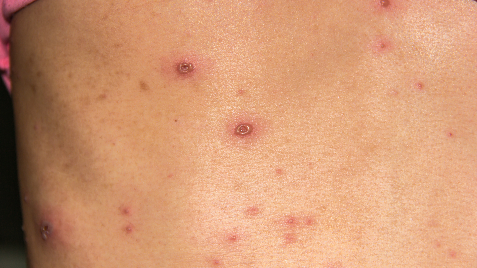 Giải đáp trực diện bị thủy đậu có được ăn bún không?