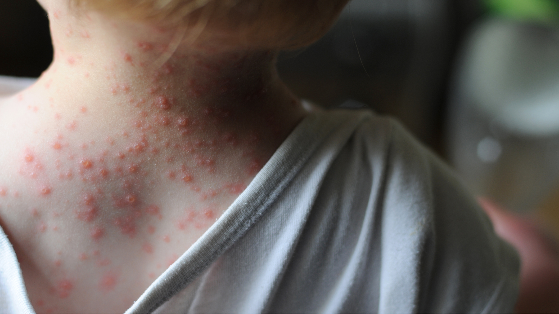 bi-thuy-dau-co-nen-tam-nuoc-muoi-khong (3).png