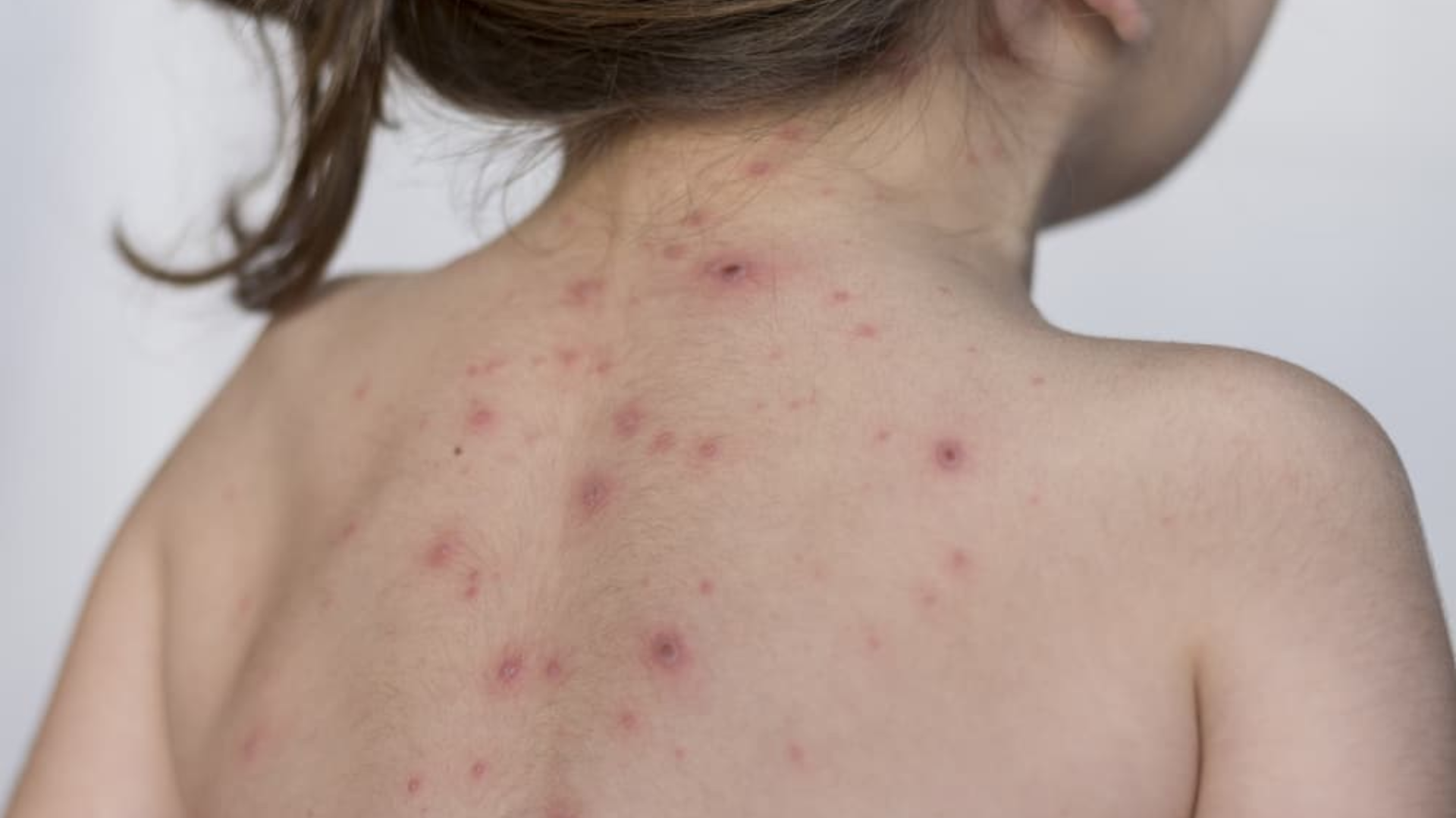 Nốt ban xuất hiện trước ở ngực lưng cổ rồi lan rộng, dần phồng to thành mụn nước chứa dịch trong viền đỏ