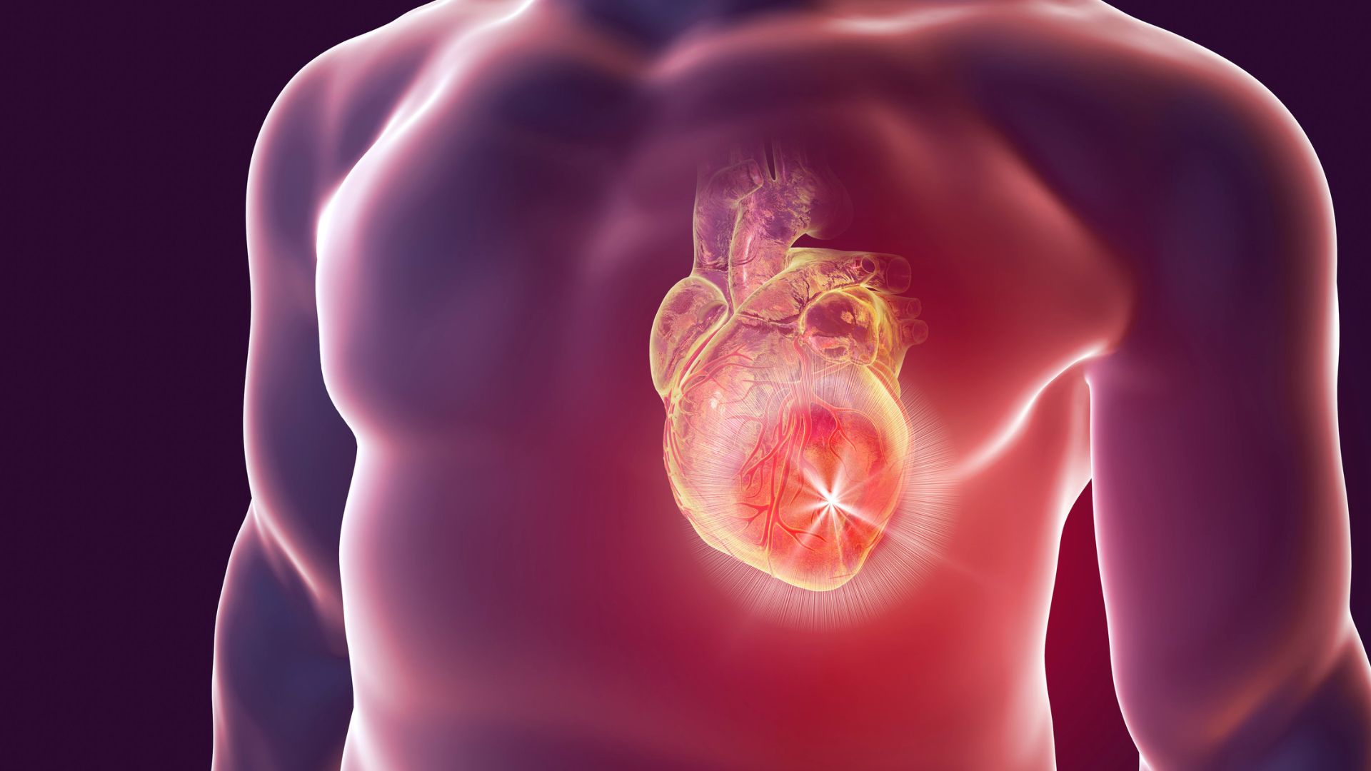 Nhồi máu cơ tim là một biến chứng mạn tính của tiểu đường