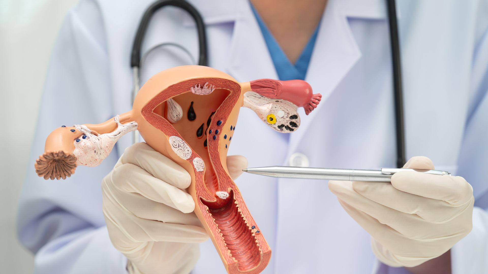 Can thiệp u bì buồng trứng đúng thời điểm giúp bảo tồn khả năng sinh sản