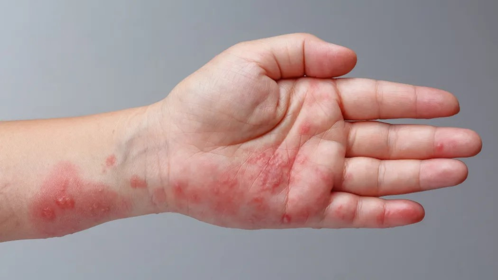 bi-zona-than-kinh-kieng-gi-de-benh-mau-chong-hoi-phuc 1.png