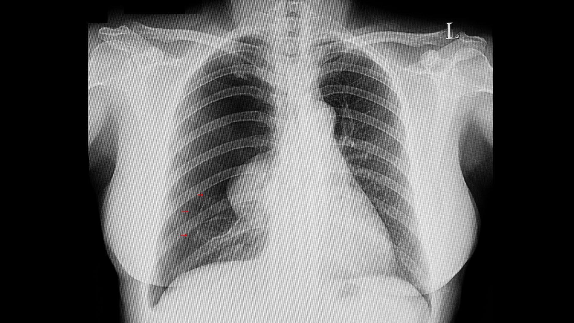 Tràn khí màng phổi là biến chứng cấp cứu có thể xảy ra đột ngột