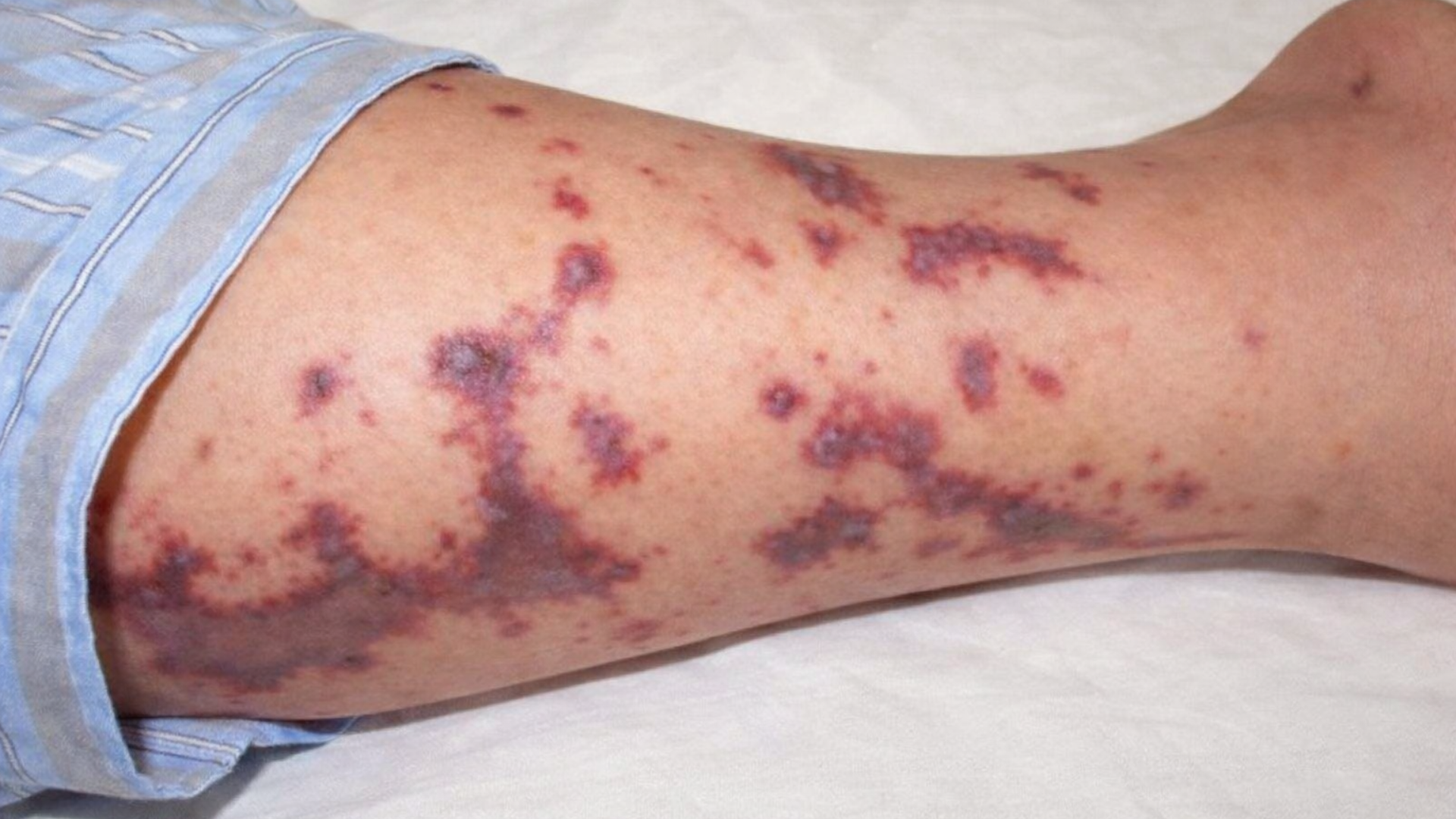 Biến chứng nguy hiểm của bệnh não mô cầu có thể diễn tiến rất nhanh