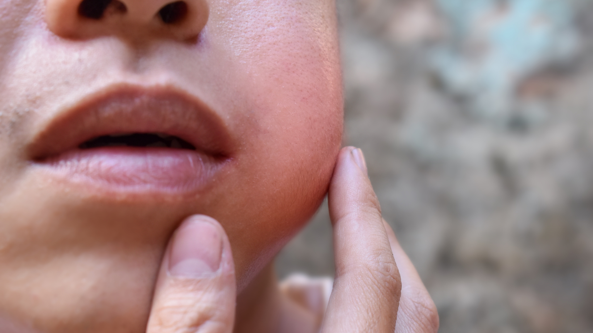 Theo dõi sau quai bị giúp phát hiện biến chứng sớm