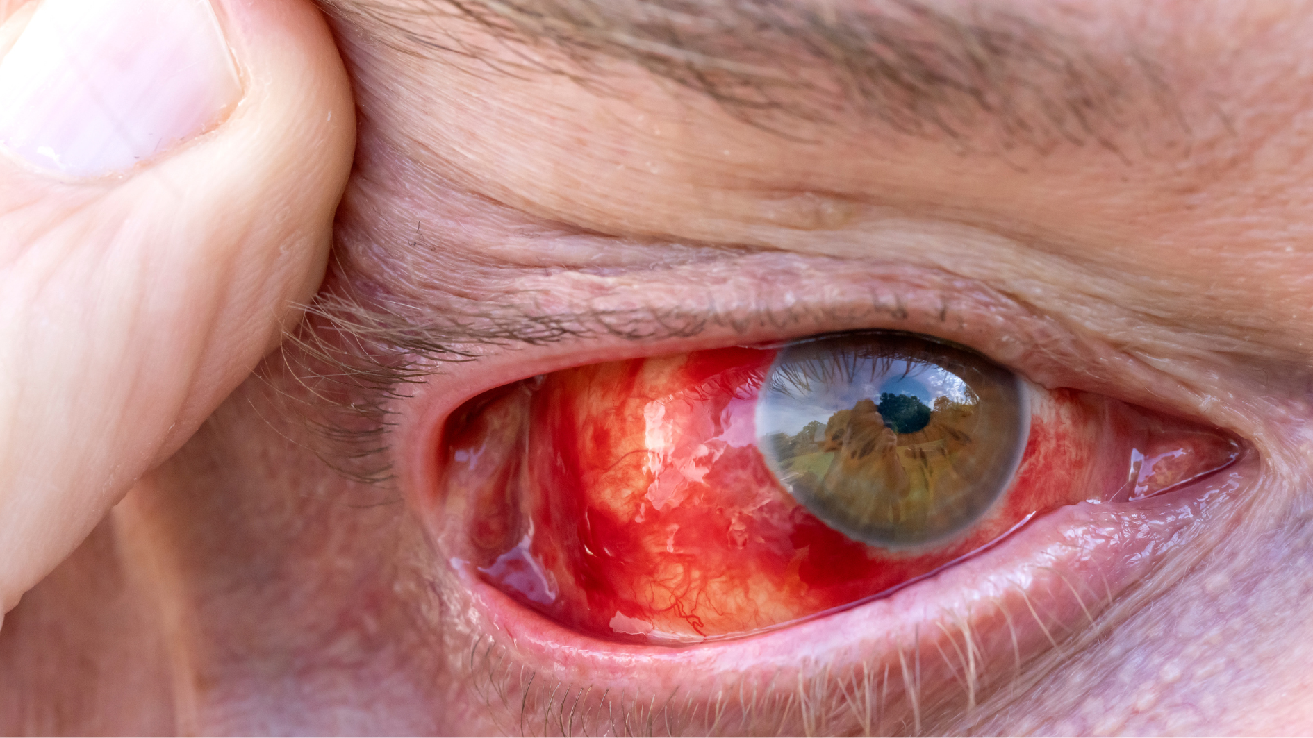 bien-chung-sot-xuat-huyet-can-luu-y (5).png