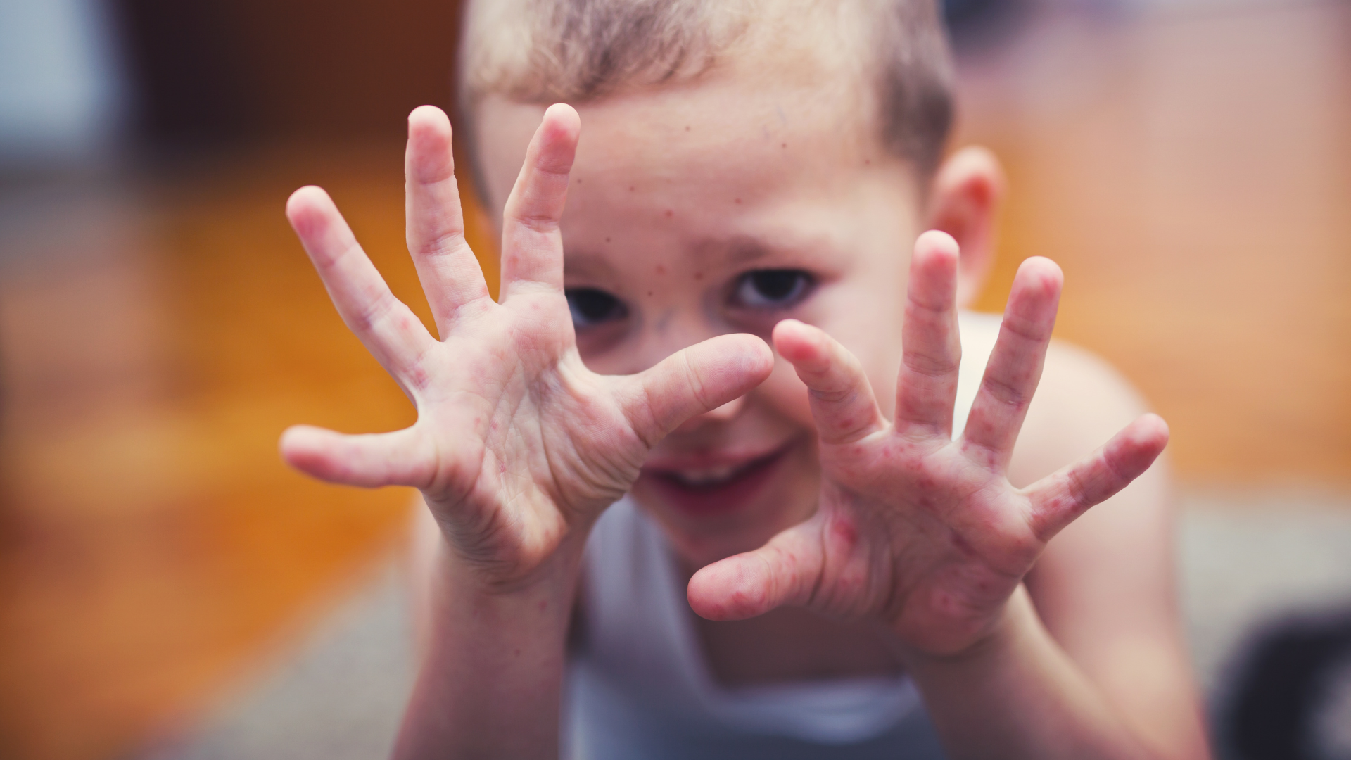 Biến thể mới gây tay chân miệng là gì và có gì khác trước