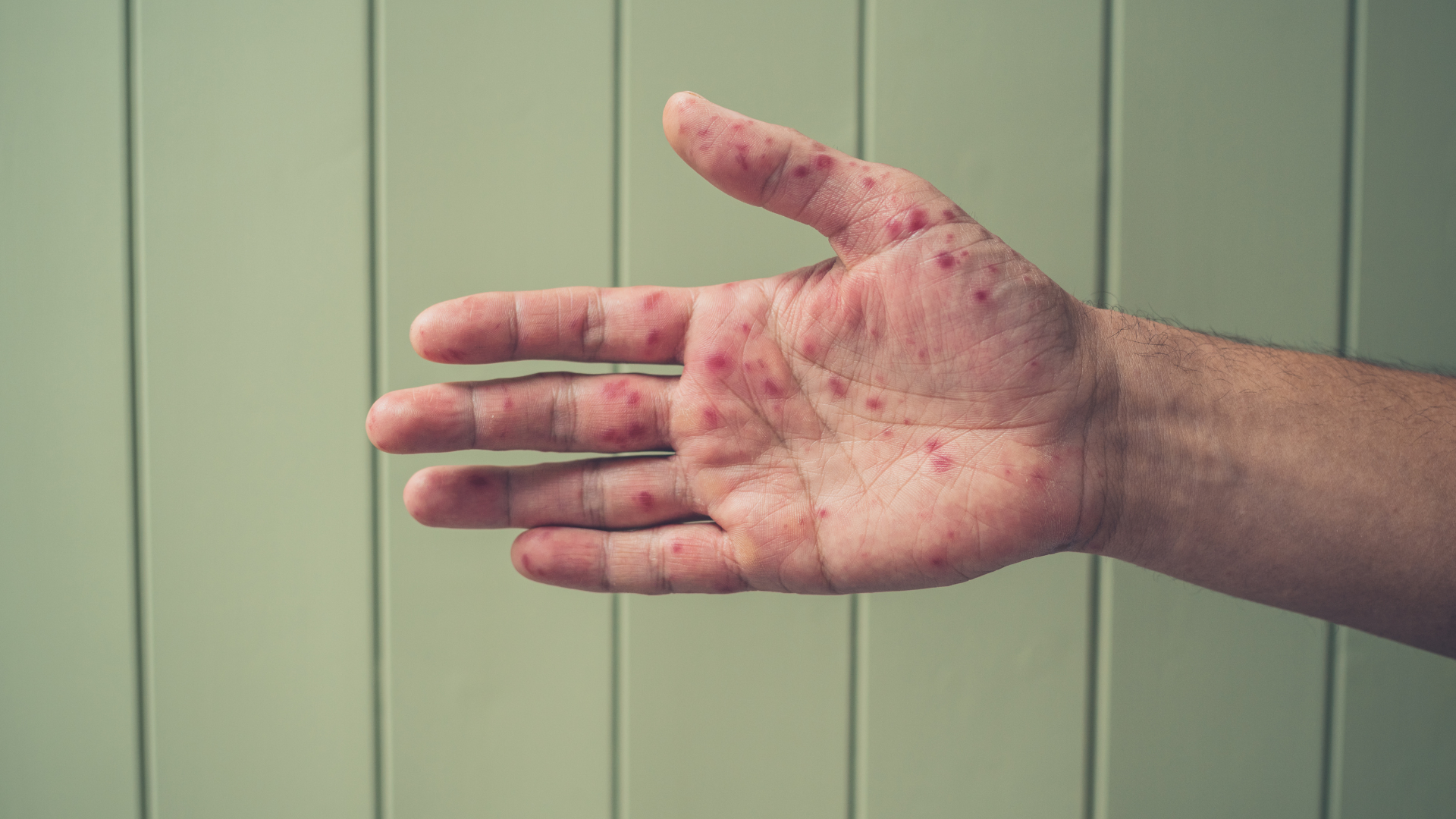 Trẻ vẫn có thể mắc lại do nhiều chủng virus khác nhau