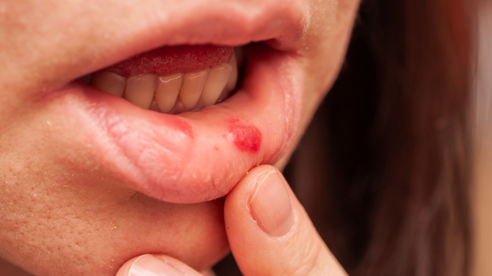 Hình thành những vết loét bên trong khoang miệng