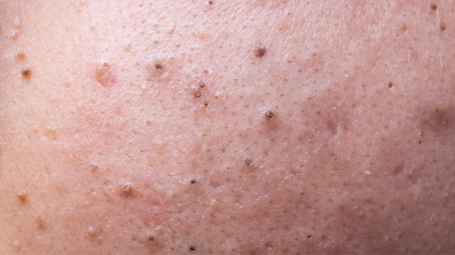 Sự bít tắc có thể biểu hiện rõ qua các loại nhân mụn không viêm