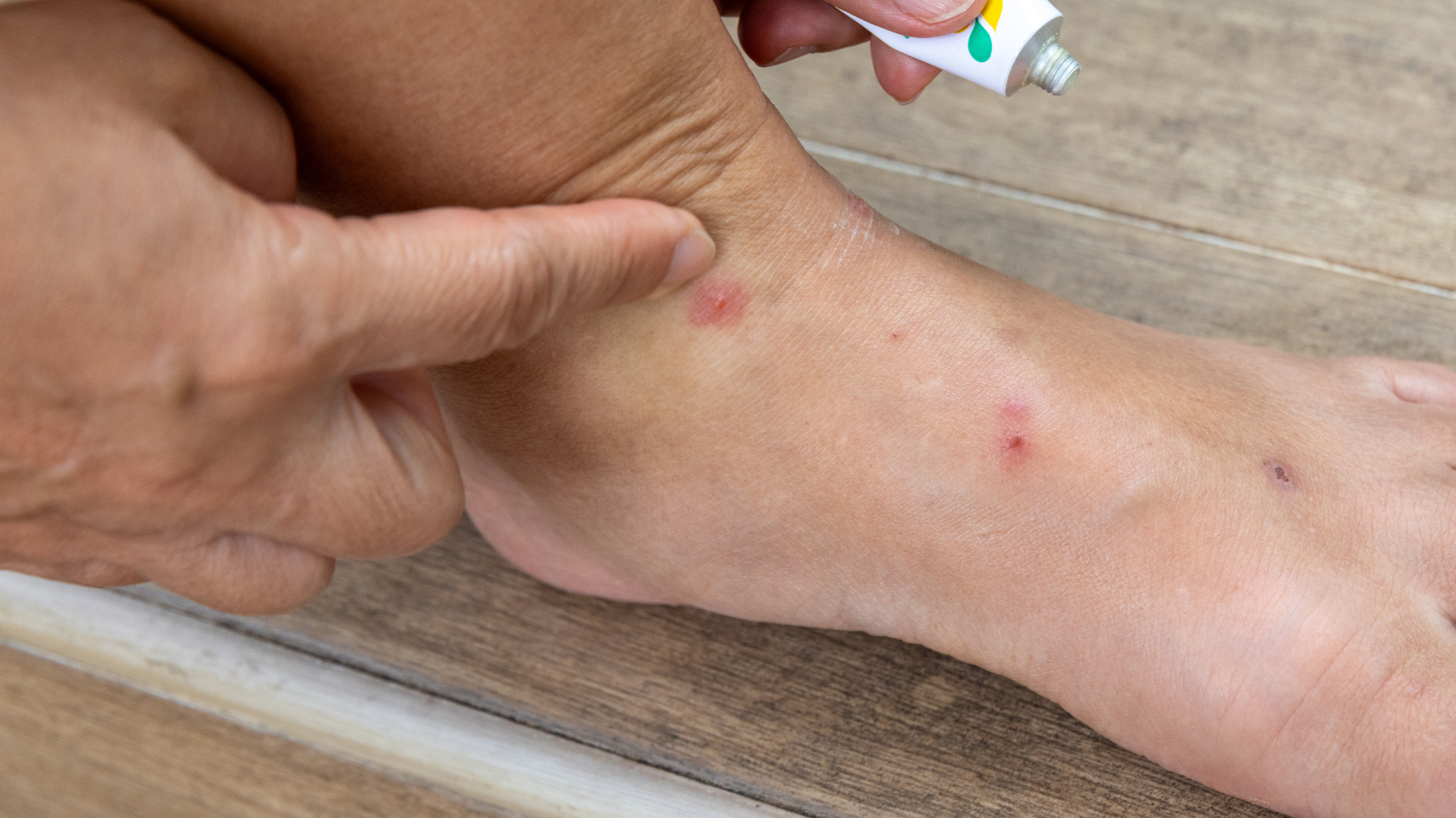 Bọ chét cắn có sao không? Giải thích dễ hiểu