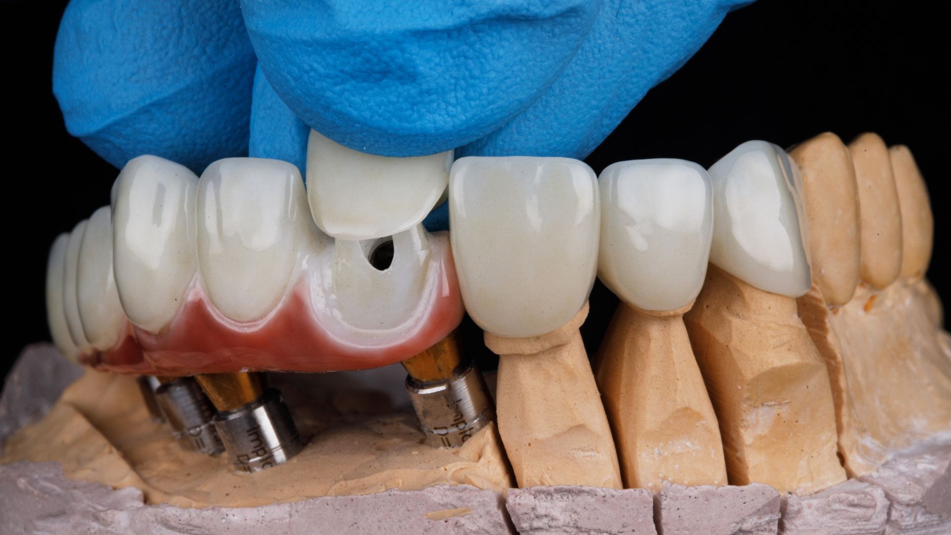 Bọc răng sứ có bị hôi miệng không phụ thuộc nhiều vào độ khít giữa mão sứ và nướu