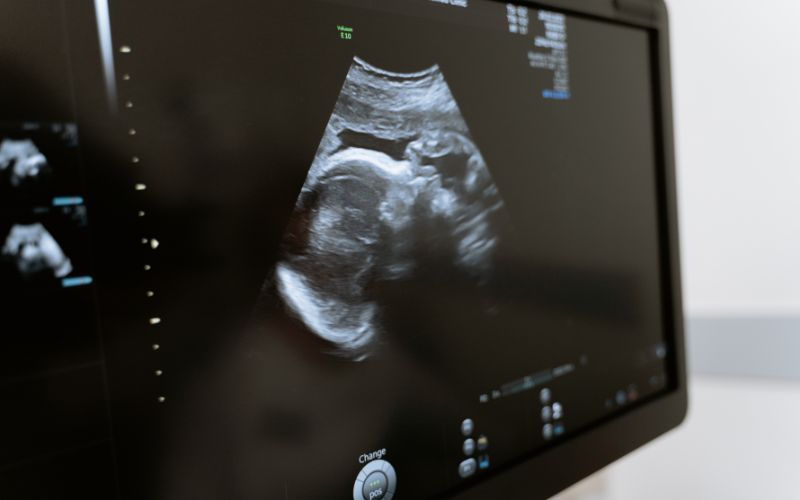 Sau khi thực hiện IUI, việc nghỉ ngơi và theo dõi đóng vai trò quan trọng để đảm bảo hiệu quả và an toàn