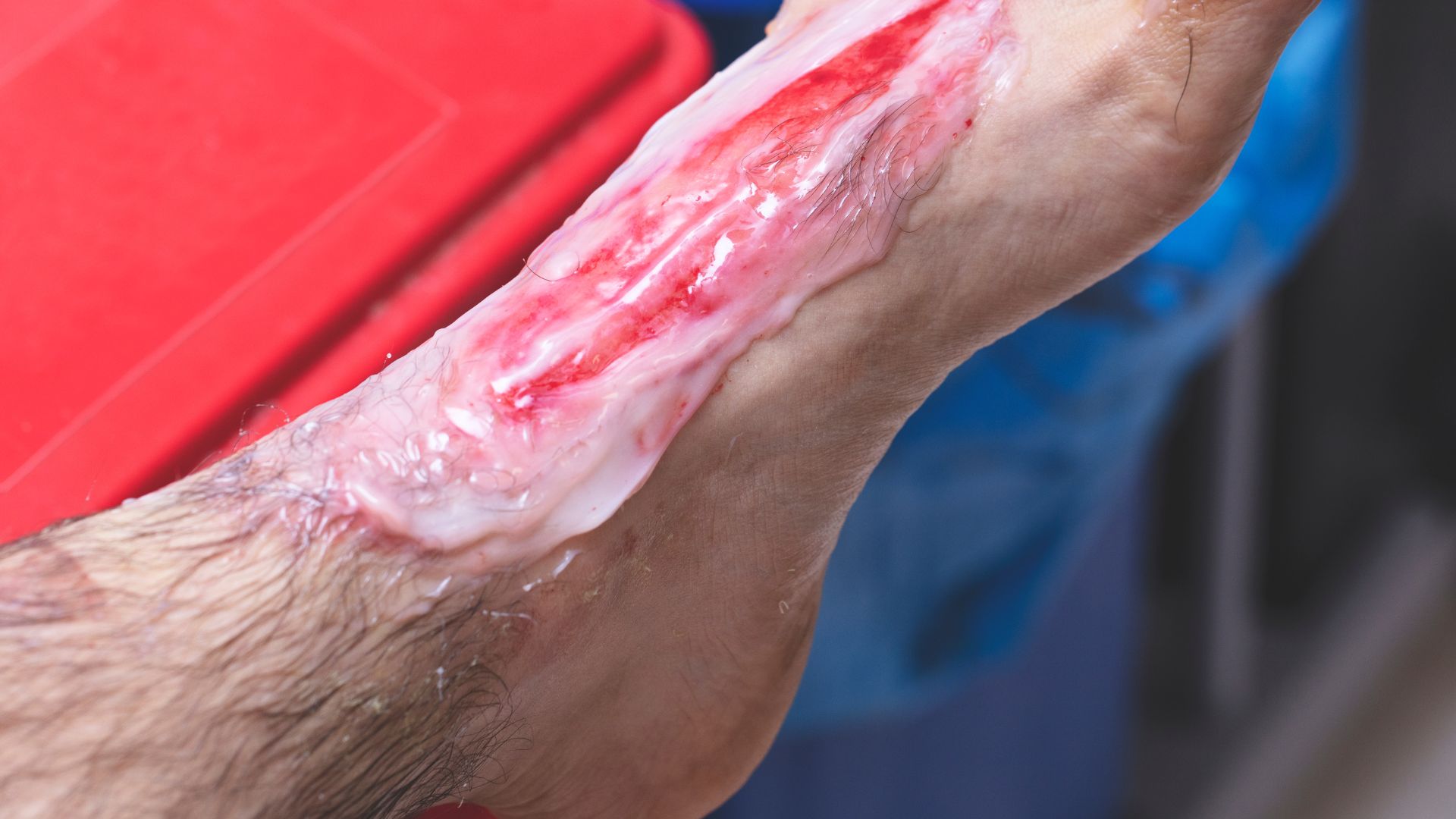 Bỏng cấp độ 3 là tình trạng da bị tổn thương nặng nề do nhiệt độ hoặc hóa chất