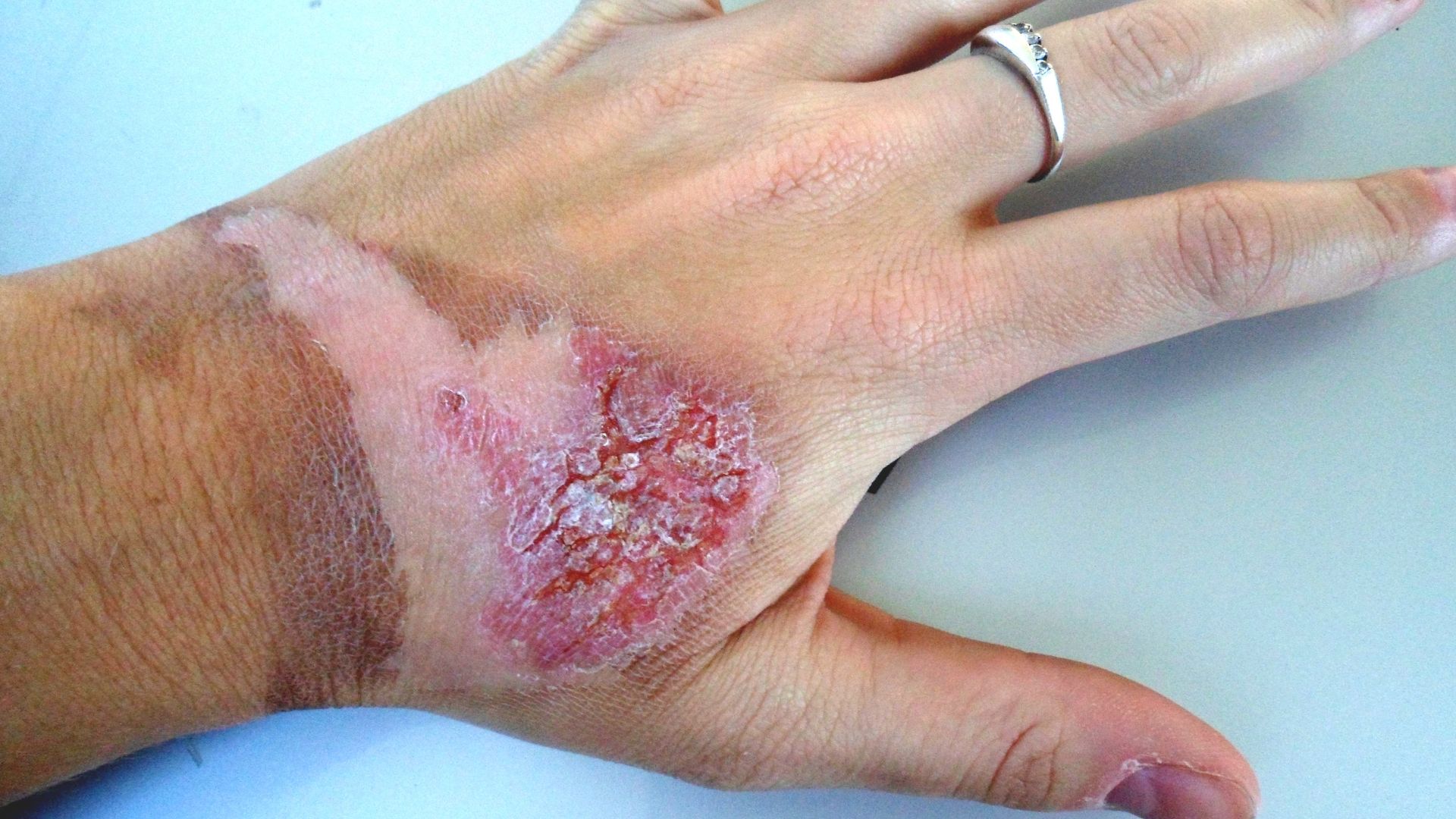 Bỏng độ 3 thường có nguy cơ để lại sẹo lớn